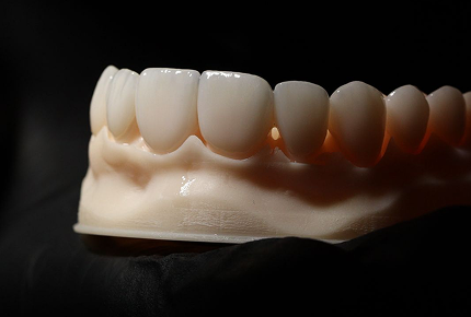 Facetas Dentárias